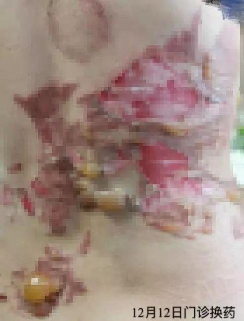 小巷特色养生馆，最新拔罐图片分享